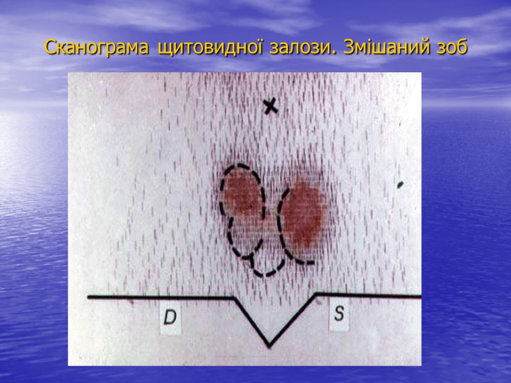 Сканограма щитовидної залози. Змішаний зоб